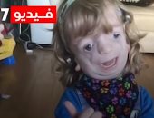 مدرسة بريطانية تمنع قبول طفل مصاب بمتلازمة وراثية نادرة.. فيديو