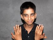صبى بـ12 إصبعاً فى الهند يؤكد سعادته لتفوقه فى الألعاب ويرفض الجراحة.. صور