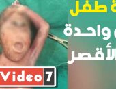 فيديو.. ولادة نادرة لطفل بـ"عين واحدة" فى الأقصر