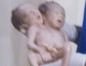 وفاة طفل برأسين بعد حالة ولادة نادرة بدار السلام فى سوهاج