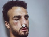 نزيف وكسر فى الأنف.. التشخيص المبدئى لإصابة مدافع الاتحاد بعد تدخل أحمد فتحى