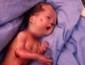 ولادة نادرة لطفل مذبوح الرقبة فى مستشفى أرمنت غرب الأقصر