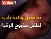 تفاصيل ولادة نادرة لطفل مذبوح الرقبة فى الأقصر.. فيديو