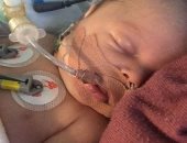قطرة لبن تسبب فى 3 نوبات قلبية خطيرة لرضيع بعمر 17 يوما.. صور