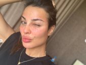 نادين نجيم x صور تبرز تغير وجهها بعد إصابتها بانفجار بيروت: شكراً يا رب على كل شىء