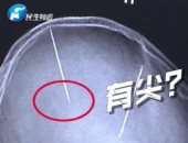 امرأة صينية تكتشف وجود "إبرتين" فى دماغها بعد تعرضها لحادث بسيط