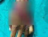 إعادة زرع كف يد شاب بعد بترها فى عملية ناجحة بجامعة طنطا.. صور