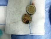 فريق طبى بمستشفى قنا الجامعى يستخرج عملة معدنية من مريء طفلة