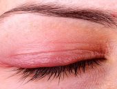 تعرف على أسباب الإصابة بالإكزيما حول العين وأعراضها المختلفة