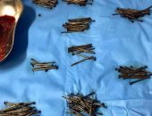 استخراج 230 مسمارا من بطن مريض بالسعودية.. صور