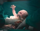 الولادة القيصرية تعرض الأطفال لخطر الإصابة بالربو والحساسية