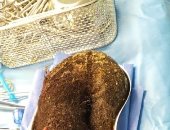 عملية جراحية لاستخراج 2.5 كيلو شعر من معدة فتاة سعودية.. والسبب غريب