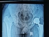 استبدال كامل لمفصل الفخذ بآخر صناعى لمريض بمستشفى المنصورة العام الجديد