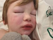إصابة طفل بريطانى بمرض نادر وفقدان للذاكرة بعد تعافيه من فيروس كورونا