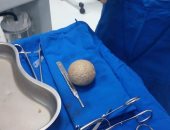 فريق طبى بالوادى الجديد ينجح فى استخراج حصوة من مثانة مريض بحجم كرة التنس.. صور