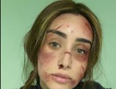 هنا الزاهد مازحة بوجه ممتلئ بالجروح والكدمات: شكلى من غير ميكب.. صورة