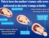 إصابة طفلين بالسرطان إثر استنشاق ورم خبيث بعنق الرحم من الأم أثناء الولادة