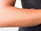 وصفات طبيعية لعلاج جلد الوزة.. الترطيب وتقشير البشرة أساسيان