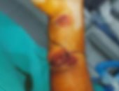 مستشفى إسنا تنجح فى إجراء عملية جراحية لطفلة تعانى من قطع كامل فى اليد اليمنى
