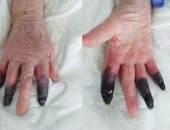 بتر أصابع امرأة إيطالية بعد تسبب أعراض غريبة لكورونا في الغرغرينا
