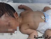إجراء عملية تركيب قسطرة مخية لطفل يبلغ من العمر 5 أيام بمستشفى الغردقة العام