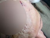 إصابة سيدة مسنة بجروح قطعية بالرأس فى مشاجرة مع جيرانها بطنطا