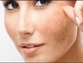 5 إسعافات أولية للنساء حال الإصابة بحرقة الوجه بسبب أشعة الشمس
