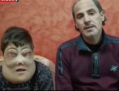 يوسف وأحمد طفلا المرض النادر يبدآن جراحات استئصال الأورام الخبيثة.. فيديو