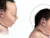 ما هو صغر حجم الرأس عند الأطفال حديثى الولادة