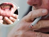 اليوم العالمي لصحة الفم.. كيف يتسبب التبغ فى الإصابة بسرطان الفم؟