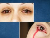 ما هى أسباب الحيض العيني؟..تعرف على مرض هيمولاكريا