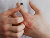  أمراض جلدية شائعة عند البالغين وطرق العلاج