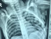 مستشفى بنى سويف التخصصى تنقذ طفل تعرض لتهتك فى الرئة بحادث سير