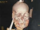 فريق طبى بجامعة أسيوط ينجح فى استخراج سيخ حديد من جمجمة شاب ثلاثينى