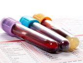 ما أهمية إجراء تحليل الكوليسترول VLDL فى الدم؟