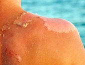 5 علاجات منزلية للتغلب على تصبغات الجلد فى الصيف