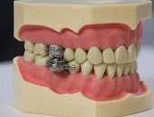  علماء يطورون "قفل أسنان" للمساعدة فى إنقاص الوزن
