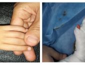 جراحة نادرة بمستشفيات طنطا الجامعية.. تحويل السبابة لإبهام بيد طفل عمره عامين