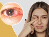 كل ما تريد معرفته عن أسباب وأعراض وعلاج  لمرض القرنية العين