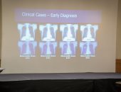 الصحة: إطلاق مبادرة للكشف المبكر عن سرطان الرئة