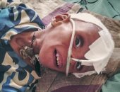تحذيرات أممية: تفشى الحصبة والكوليرا يهدد حياة الأطفال فى إثيوبيا