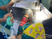 أطباء بسوهاج يعيدون يد طفلة 8 سنوات لطبيعتها بعد دخولها فى مفرمة لحوم