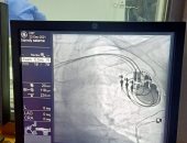 لأول مرة.. فريق طبى ببنها التعليمى يركب جهاز منظم ثلاثى الحجرات لمريض قلب