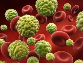 أعراض غير معروفة لسرطان الدم.. أبرزها تورم الغدد
