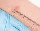 اختبار مانتو للجلد.. أهم طرق تشخيص مرض السل