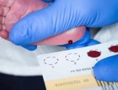 اسكتلندا تفحص حديثى الولادة للكشف المبكر عن ضمور العضلات الشوكى