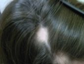 أبرز علامات وأعراض داء الثعلبة لو بتعاني من تساقط شعر فى بعض مناطق الرأس