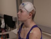 فتاة تتعافى من شظية استقرت بمنتصف دماغها أثناء الحرب الروسية الأوكرانية