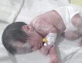 حضانة مستشفى عزبه البرج بدمياط تستقبل حالة نادره لطفل شمعي