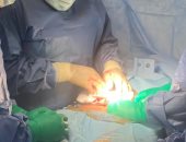 وكيل "صحة السويس" يجرى جراحة ناجحة لإزالة ورم ليفى لسيدة مع الاحتفاظ بالرحم